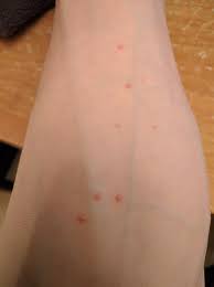 What happens is the body produces histamine in response to a person's own sweat, causing a hypersensitivity reaction that. Skin Concerns What Are These Red Bumps On My Arm And How Do I Get Rid Of Them Skincareaddiction