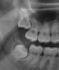 There are other affordable ways to get your wisdom teeth removed how much does it cost to have 4 wisdom teeth removed? Wisdom Tooth Extraction Impacted Wisdom Teeth Removal Albany