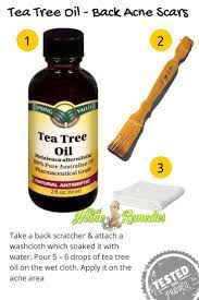 Back Acne Bacne Means Acne Which Comes On The Backside Skin Breaks Out With Blackheads Pimples Left Sca Tea Tree Oil For Acne Tea Tree Oil Tea Tree Oil Face