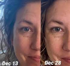 How to use retinol for fine lines?