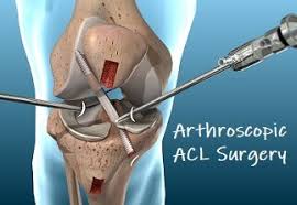 Acl reconstruction surgery three risk factors for a second acl injury risk for retearing the acl or tearing the. Acl Rehab Protocol Following Surgery Knee Pain Explained