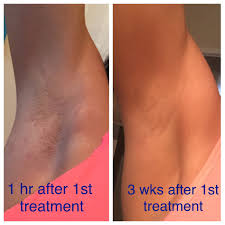 Your unwanted hair needs to fall out on its own in order to see the laser hair removal doesn't guarantee to remove 100% of your unwanted hair, but the few stragglers that do grow back are pretty much unnoticeable. How Effective Is Laser Hair Removal After First Treatment