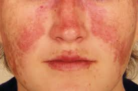 Image result for red rash face