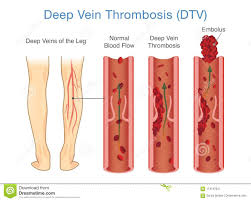 Medical Diagram Of Deep Vein Thrombosis At Leg Area Stock