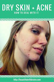 How To Deal With Acne And Dry Skin Dry Skin Acne Dry Skin On Face Dry Skin Care Routine