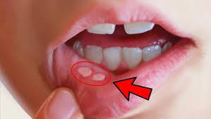 Image result for Canker sores symptoms roof of the mouth
