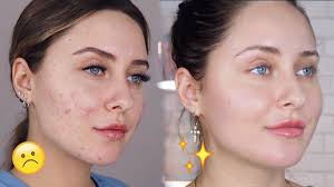 Acne scars are usually pitted and almost never heal completely. How To Get Rid Of Acne Scars Dark Spots Youtube
