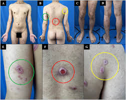 Image result for syphilis ulcer