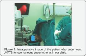 Awake Non Entubated Video Assisted Thoracoscopic Surgery Juniper Publishers With Images Airway Management Oxygen Therapy Reduction Surgery