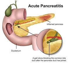 Getty images ) if you are over 60, have lost weight and have diarrhoea or constipation, your gp should refer you. Dietary Guidelines For Pancreatitis