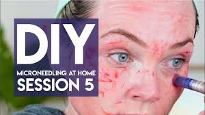 How To Microneedle At Home Session 5 With Dr Pen A6 Youtube Doctor Pen Microneedling Derma Pen