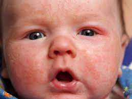 No Eczema Benefit To Partially Hydrolysed Whey Formula