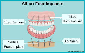 Typically, basic dental insurance doesn't cover dental implants, although some insurance companies offer premium. All On 4 Dental Implants Mexico Costs Clinics And Procedure