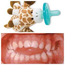 Protrusive upper front teeth (front teeth stick out) and crossbite (teeth overlap the opposite of how they should. Pin On Pediatric Dentist