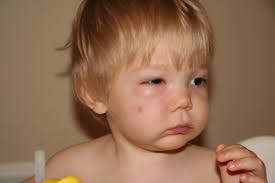 Skeeter syndrome (papular urticaria) is a localized allergic reaction to mosquito bites,1 consisting of inflammation and sometimes fever. Suburban Vampires Amalah Com