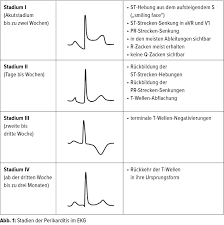 .herzinfarktes ist das aufzeichnen der herzstromkurve durch ein elektrokardiogramm (ekg). Die Perikarditis Im Ekg Abgrenzung Zum Myokardinfarkt Kardiologie Gefassmedizin Universimed Medizin Im Fokus