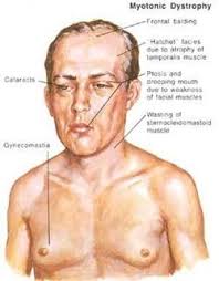 Pathology Definition Myotonic Dystrophy Myotonic Dystrophy Pathology Muscular Dystrophies