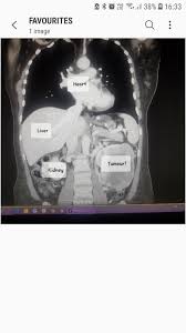 Ovarian cancer affects the ovaries, which are a small pair of organs located in the female pelvic cavity. My Doctor Told Me It Was Heartburn For 8 Months Cancerous Tumour Encapsulated The Kidney When Removed It Was The Size Of A Honey Dew Melon And Hadn T Spread Oncologist Couldn T