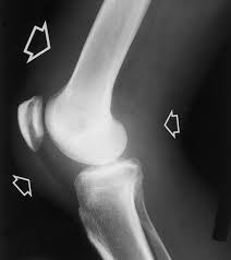 Image result for Septic Joint