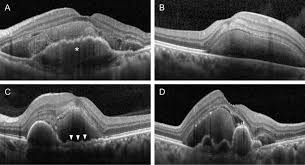 Fibrovascular pigment epithelial detachment in eyes with subretinal  hemorrhage secondary to neovascular AMD or PCV: a morphologic predictor  associated with poor treatment outcomes | Scientific Reports