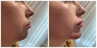 Maybe you would like to learn more about one of these? How To Create A Balanced Facial Profile Without Surgery The Look Facial Aesthetic Boutique