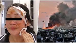 Video] Pinay OFW Shares Her Experiences, Bares Wounds Sustained from Beirut  Blast
