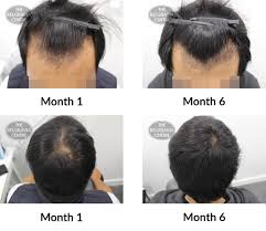 The human body, apart from areas of glabrous skin, is covered in follicles which produce thick terminal and fine vellus hair. Hair Growth Success Story I M Very Happy
