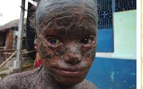 Menino de 10 anos sofre de condi&ccedil;&atilde;o rara que o deixa com 'pele de cobra' |  Sa&uacute;de | iG