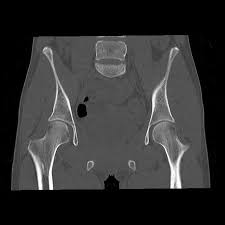 We did not find results for: Normal Pelvis Ct Radiology Case Radiopaedia Org