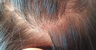 Jangkitan kulat pada kulit boleh mempunyai gejala yang sangat serupa dengan keadaan kulit yang lain, seperti dermatitis seborrheic, psoriasis, dermatitis atopik, dermatitis kontak, atau bahkan penyakit lyme. 10 Rawatan Kulit Kepala Kering Di Rumah The Diagnosa