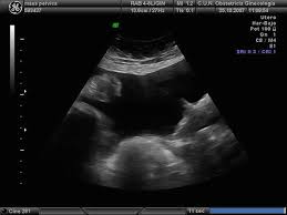 Signs and symptoms of ovarian cancer ultrasound1 (ultrasonography) uses sound waves to create an image on a video screen. Ovarian Tumors Serous Mucinous Endometrioid Clear Cell Carcinoma Clinical Setting And Ultrasound Appearance Radiology Key