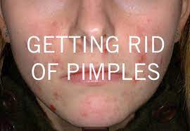 Get Rid Of Pimples With These Household Items How To Get Rid Of Pimples Painful Pimple Pimples On Forehead