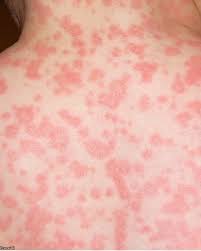 Some people like children and babies often suffer from this, and being overweight can also cause this. Sun Rash 4 Reasons By Pk Lassiter