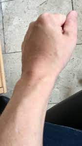 Grosse Angst Vor Thrombose Und Mehr Gnubbel Auf Vene Mit Bild Blut Venen