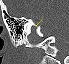 Bones of the calvaria | skull anatomy. Imaging Of Jugular Foramen Radiology Key
