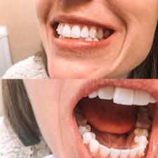 It functions by preventing your teeth from shifting back to their previous position. Invisalign Before And After Hello Adams Family
