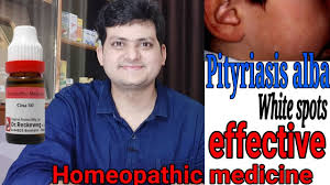 Individuals with such a type of skin disorder can be present in any of the followings stages:. Homeopathic Medicine For White Spot On Face Of Children à¤¬à¤š à¤š à¤• à¤š à¤¹à¤° à¤® à¤¸à¤« à¤¦ à¤¦ à¤— Youtube