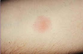 10 mm.measured induration after 48 hours. What Does A Positive Tb Skin Test Look Like