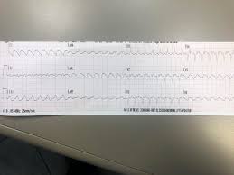 The ecg below shows a lbbb morphology with a rapid rate. This Ones Got Me Effed Up Vt Or Svt W Aberrancy Ekgs