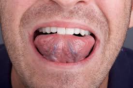 Most of the time lip cancer does not show any signs at the earlier stage and the first signs are dependent on according to studies, sore on the lips remains most common early sign and second most common presentation because of that patient does not feel anything while touching the lips. Self Oral Cancer Screening Socs Education Program School Of Dentistry Lsu Health New Orleans