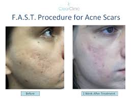 Maybe you would like to learn more about one of these? Can You Fix Ice Pick Scars