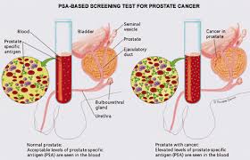 Image result for Prostate Specific Antigen