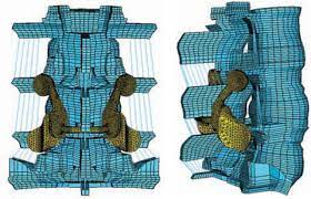 Anatomic Facet Replacement System Afrs Restoration Of Lumbar Segment Mechanics To Intact A Finite Element Study And In Vitro Cadaver Investigation International Journal Of Spine Surgery