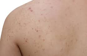Image result for folliculitis symptoms