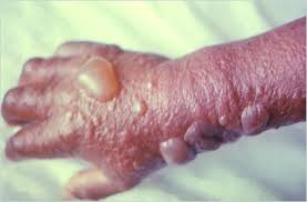 Image result for Anthrax