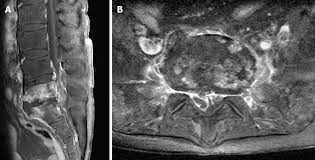 Image result for Spinal Epidural Abscess