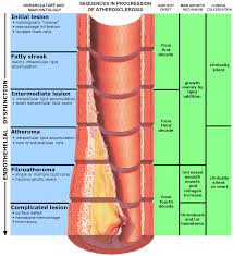 Atherosclerosis Wikipedia