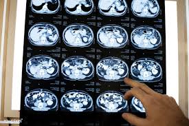 Download Premium Image Of Brain Ct Scan X Ray Film 260602 Nootropics Brain Nootropics Brain Enhancement