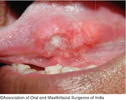 Image result for spinocellular carcinoma of the oral cavity