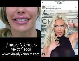 SIMPLY VENEERS